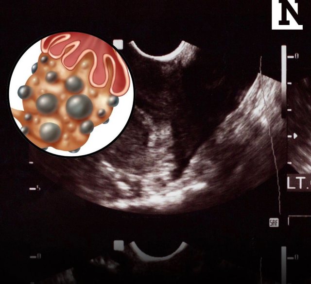 PCOS riemërtohet zyrtarisht në PMOS